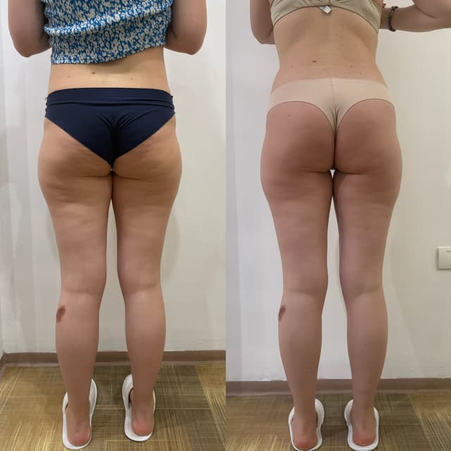 Masaža — Angelore body shape, Vukov spomenik